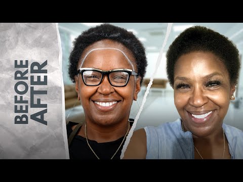 Restored Edges & Hairline | 3000 Grafts Female Afro Hair Transplant at Heva Clinic ✨