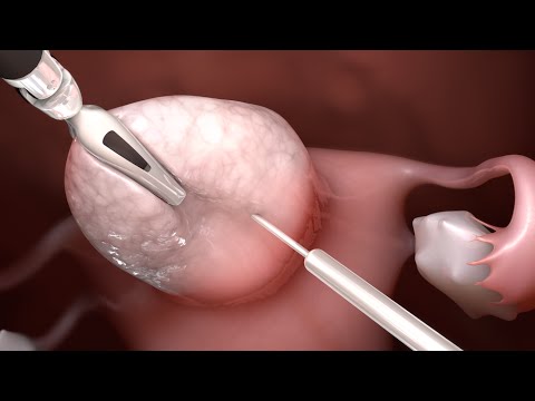 Uterine Fibroid Surgery - Robotic Myomectomy