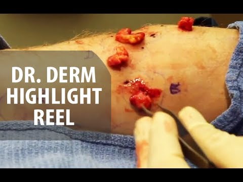 Cyst Popping Highlight Compilations Video