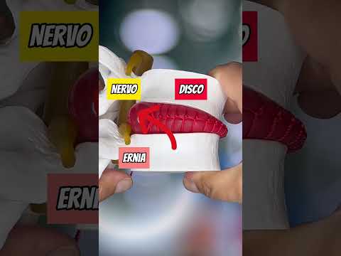 Come l'ernia del disco comprime i tuoi nervi