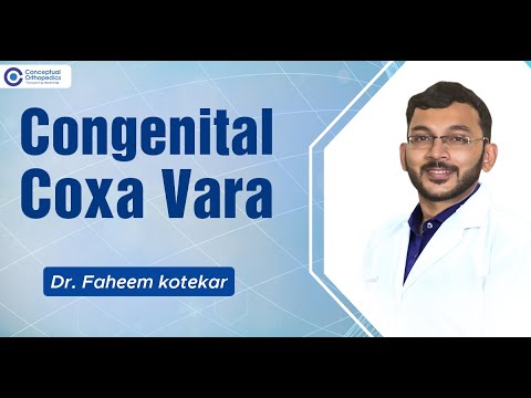Congenital Coxa Vara by Dr. Faheem Kotekar @ConceptualOrthopedics