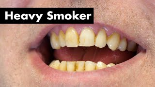 Cleaning Smoker's Teeth with Heavy Stain | Teeth Cleaning