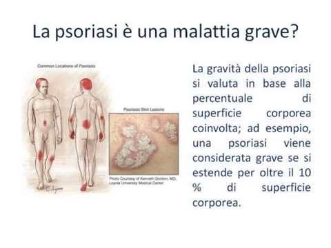Se lozonoterapiya aiuterà a psoriasi La psoriasi da quello che sviluppa