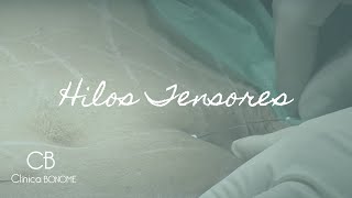 TRATAMIENTO CON HILOS TENSORES DE PDO A NIVEL CORPORAL x CLÍNICA BONOME