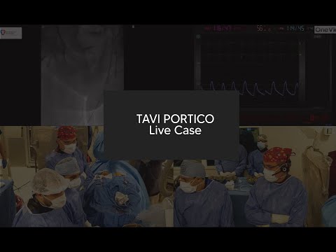 TAVI Portico Live Case