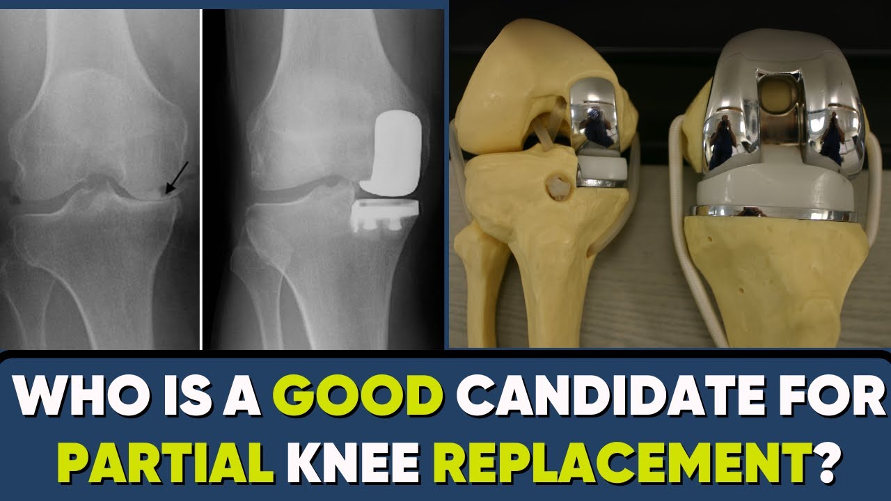 Partial knee-Who needs it ? #unicondylarkneereplacement #ukr