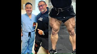 Quad surgery recovery update