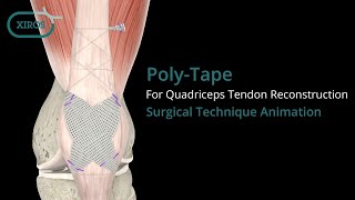 Poly-Tape for Quadriceps Tendon Reconstruction Surgical Technique Animation