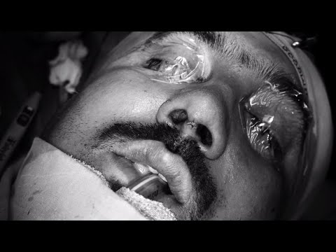 Revision Rhinoplasty For The Nose