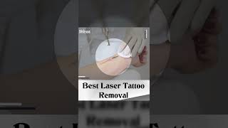 Laser Tattoo Removal | Viral #shorts