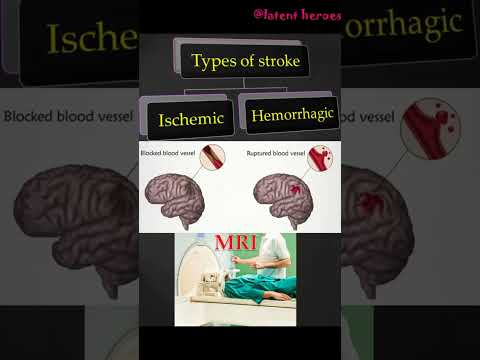 Quick MR Stroke Protocol      #MRI