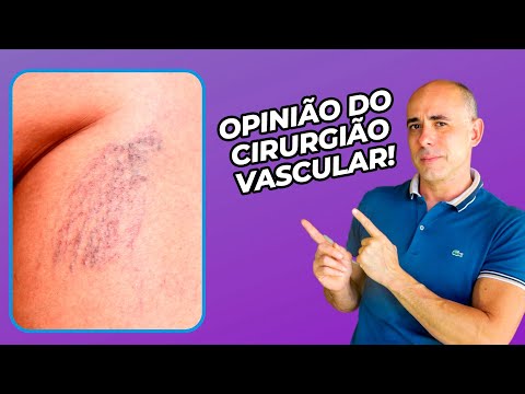 COMO SE LIVRAR DOS VASINHOS DAS PERNAS | Dr Dayan Siebra