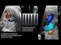 Step by Step analyses of a fetal echo case