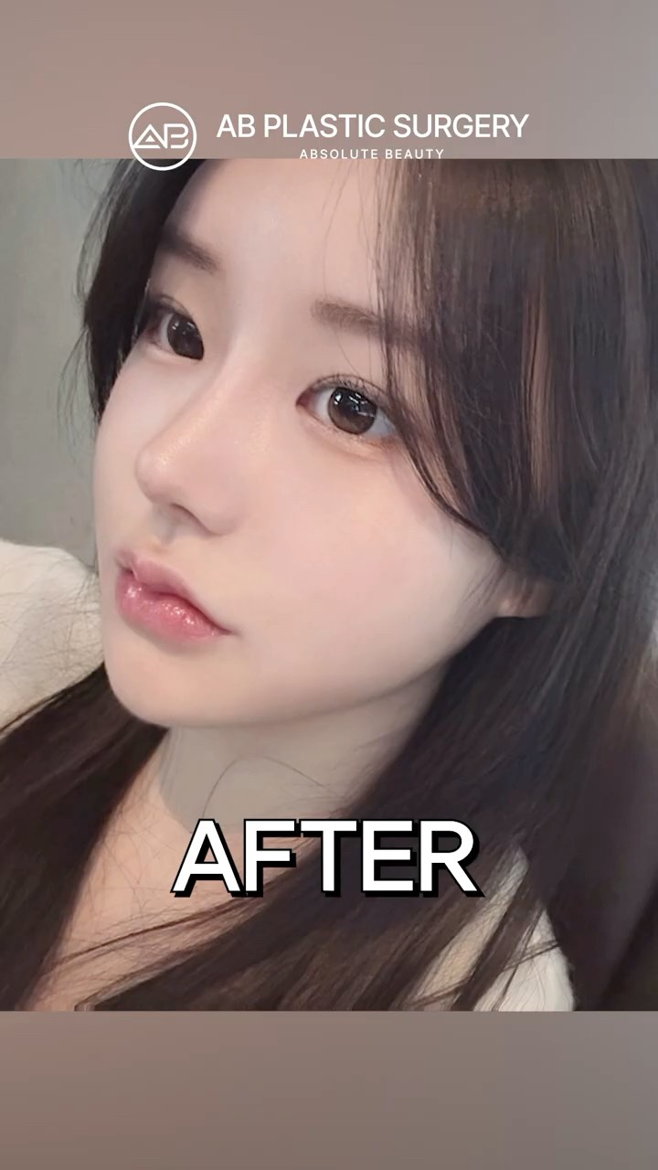 She Got Facial Surgery in Korea, Look at the Difference