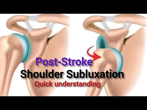 Medical Insight: Post-Stroke Shoulder Subluxation: Causes, Physiotherapy Treatments Explained"