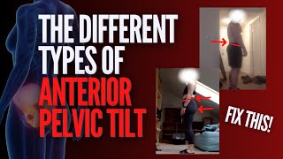 Fix Anterior Pelvic Tilt Based on YOUR Body Type (3‑Step Self Test + Routine)
