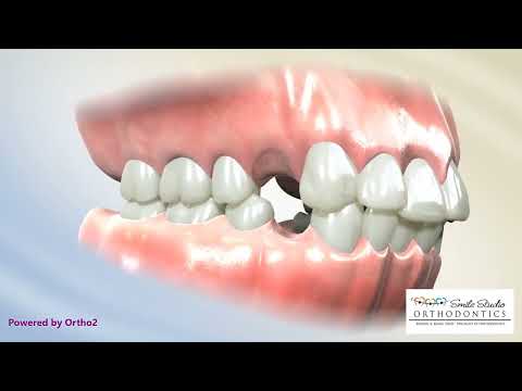 4 Pre Molar Extractions for bimaxillary protrusion