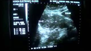 preview picture of video 'UTERINE FUNDAL REGION  FIBROID with thinning of the MYOMETRIUM'