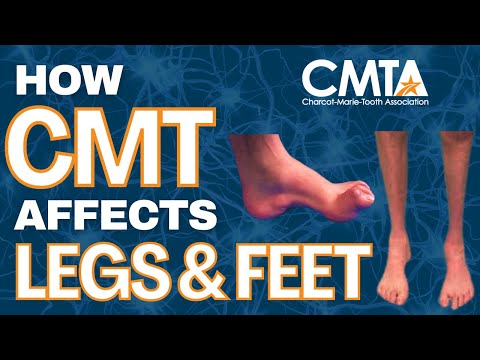 How Charcot-Marie-Tooth Disease (CMT) Affects Legs & Feet | Why Ankle-Foot Orthoses (AFOs) Matter