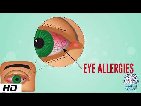 Eye Allergy, Causes, Signs and Symptoms, Diagnosis and Treatment.