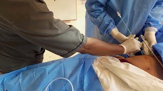 PCN Catheter)How to insert Percutaneous Nephrostomy Catheter in Human Gallbladder Complete procedure