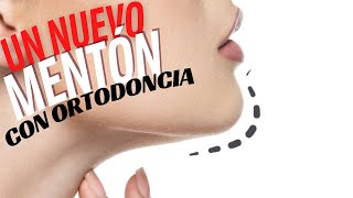 ¿COMO TENER UN NUEVO MENTÓN SIN CIRUGÍA / AUMENTO DE MENTÓN CON BRACKETS