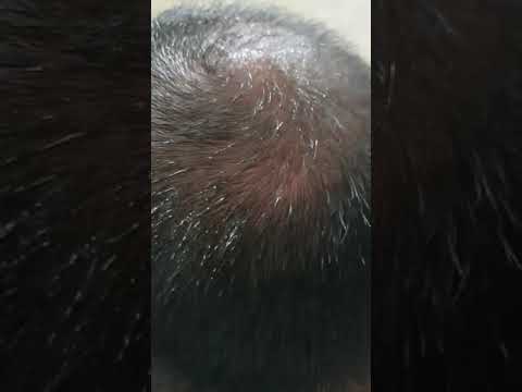 Côn Trùng Độc Các Loại Cắn Đốt