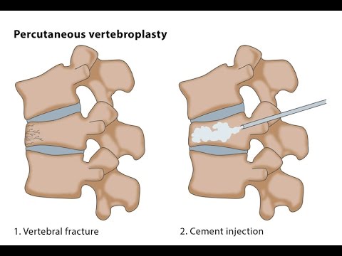 Percutaneous Vertebroplasty - Step Wise Demonstration Of The Technique