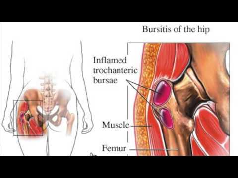 Greater Trochanteric Bursa (GTB) Injection