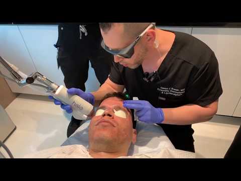 WHAT TO EXPECT FROM THE HALO LASER | ACNE SCARRING COMBINATION TREATMENT | Dr. Jason Emer