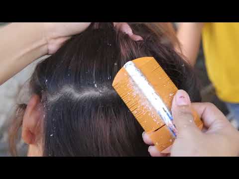 Huge Flakes!!! Scratching dandruff Scalp Itching with Sister's Head