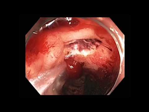 Colonoscopy: Post-radiation Telangiectasia with an Ulcer