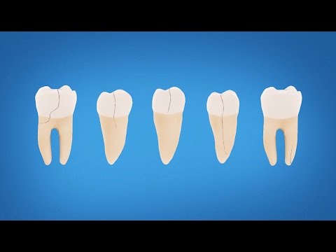 Understanding Cracked Tooth Treatment and Symptoms