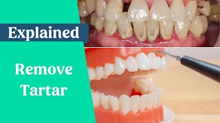 How to remove tartar from teeth without a dentist
