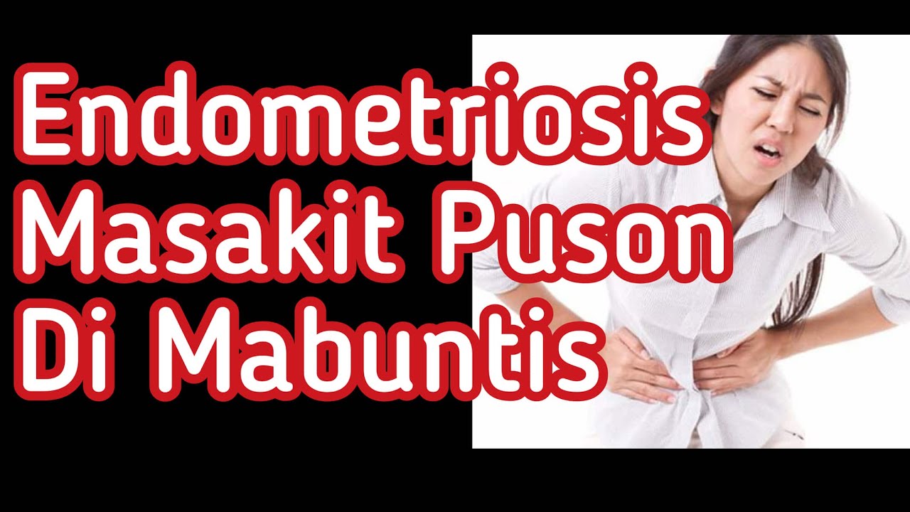 Endometriosis: Masakit Puson at Hindi Mabuntis - Payo ni Doc Willie Ong #804