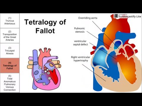 Cyanotic Congenital Heart Diseases