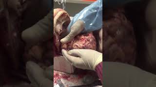 Removing the human brain during autopsy