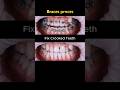 Braces process. 24 months to fix crooked teeth case #braces #dentist #orthodontist