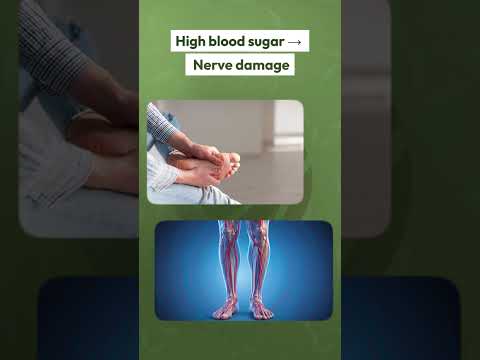 Diabetic Foot Explained by Dr. Muddappa P.P.