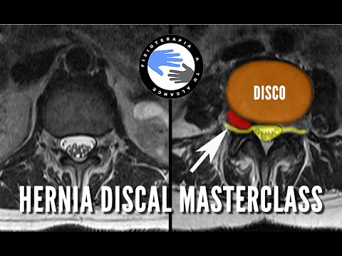 La VERDAD sobre las hernias discales