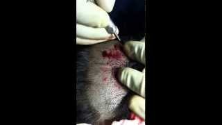 preview picture of video 'Hair Transplant In Chandigarh'