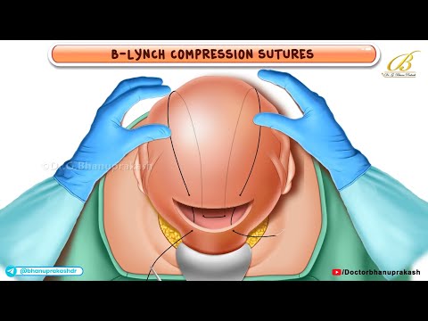 B - Lynch compression sutures Animation🏥A Lifesaver in Postpartum Hemorrhage / USMLE