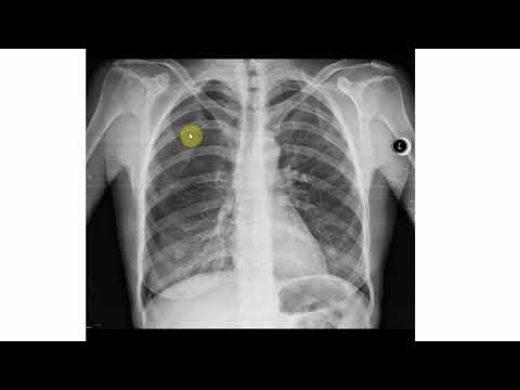 Pneumothorax Röntgen Beispiele erklärt