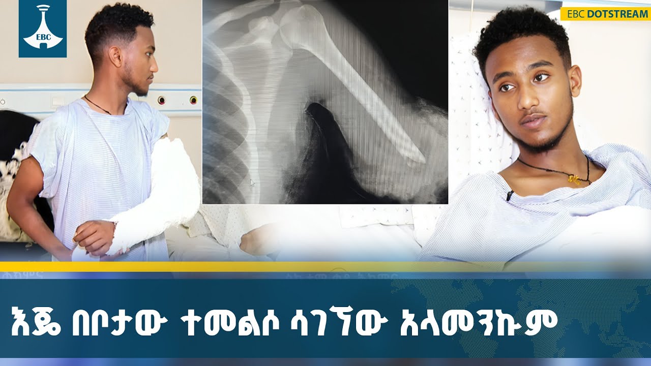 ሙሉ ለሙሉ የተቆረጠ እጅን መልሶ ከቦታው ያኖረው አስደናቂ ቀዶ ሕክምና | Surgery | Ethiopia | Sa