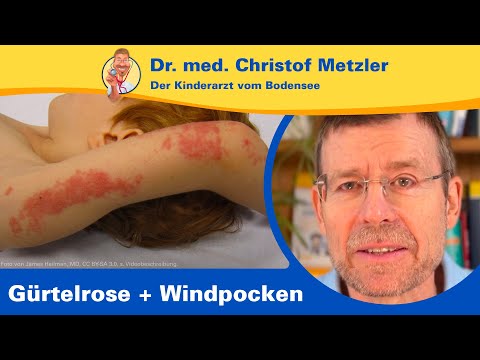 Gürtelrose: Wie erkennen, behandeln und verhindern? – Der Kinderarzt vom Bodensee