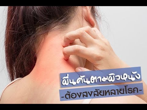 วิตามินสำหรับการรักษา neurodermatitis ขั้นตอนที่ 1 รูปภาพโรคสะเก็ดเงิน