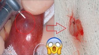 Home Remedies To Get Rid Of Mucocele (Mucous Cyst) For Good