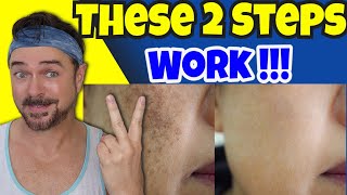 Easily Fade Dark Skin Spots In Just 2 steps!  | Chris Gibson