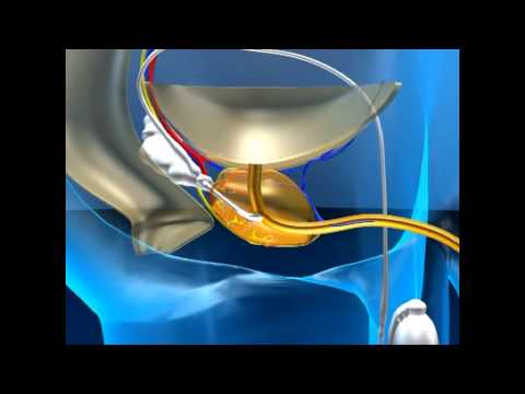 Das beste Medikament für Prostata-Adenom Prostata PSA 39