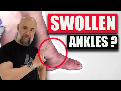 Swollen Ankles? Do This NOW